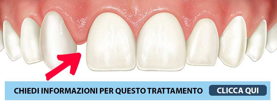 Agenesia dentale o mancanza congenita di uno o più denti latina